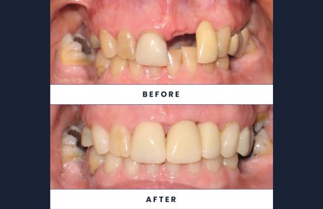 A Two-Year Journey to a Healthy Smile: Kat’s Transformation