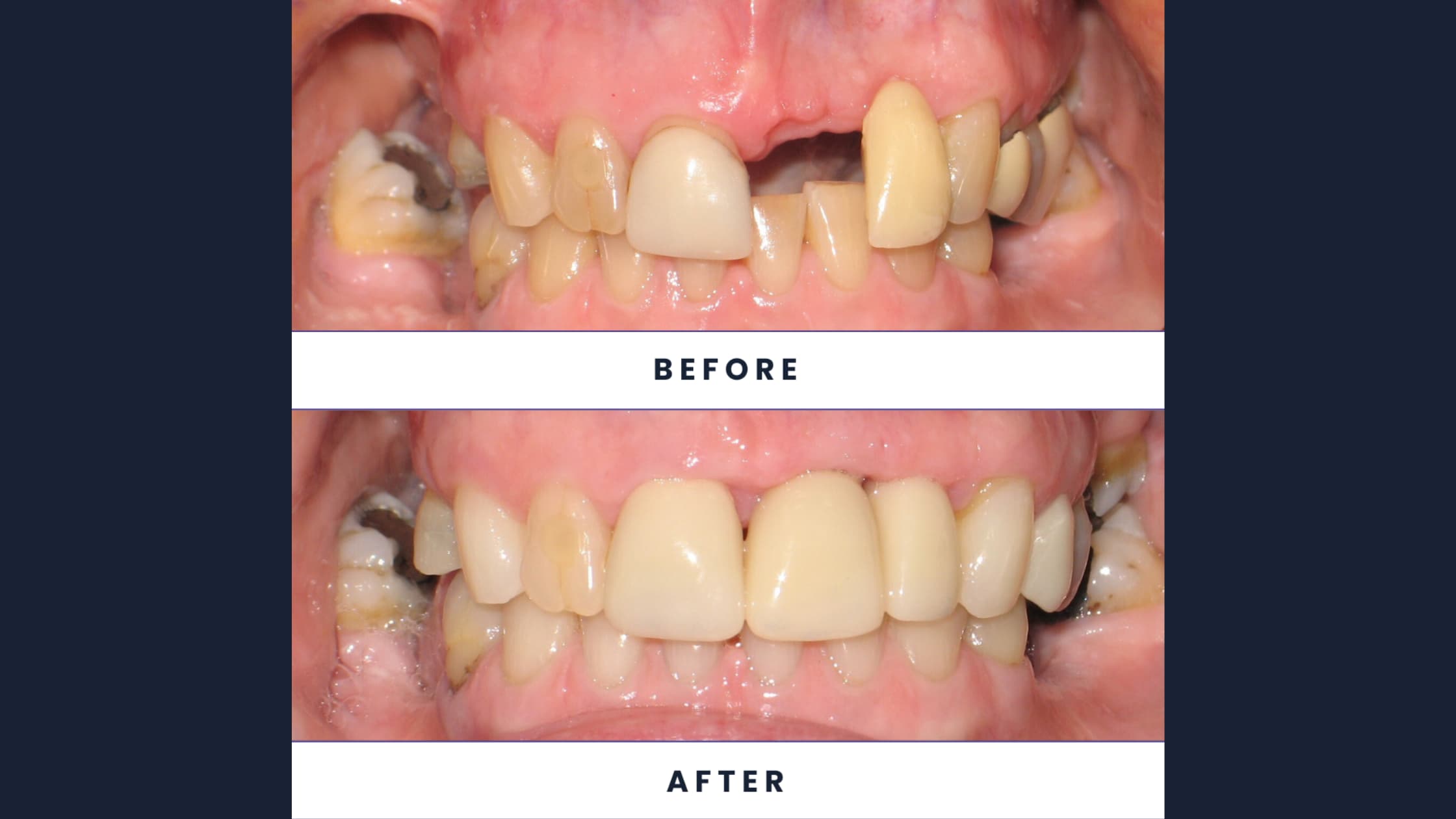 Kat’s Smile Transformation