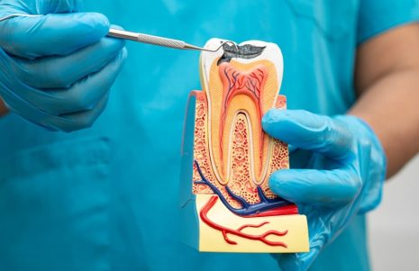 How Root Canal Treatment Works and Why It Is Done