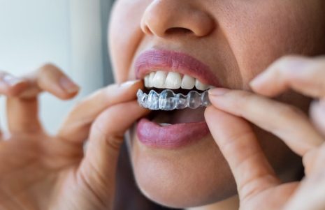 SureSmile Aligners at Roseville Dental: A Clear Option for Straighter Teeth