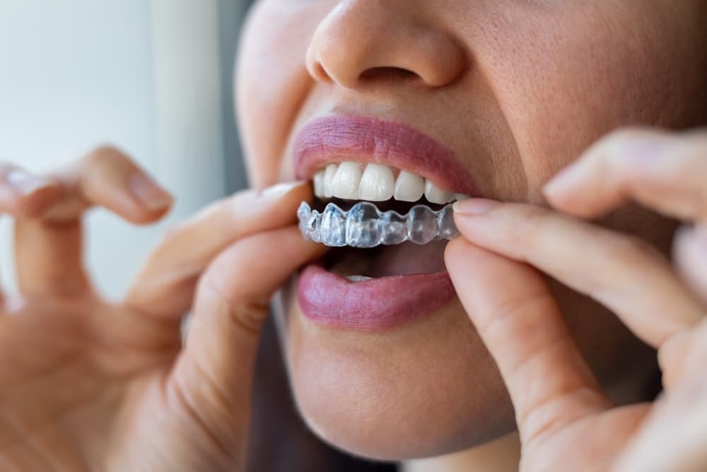 teeth straightening Roseville