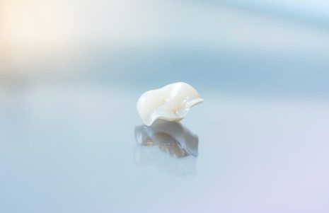 Benefits of Choosing an Inlay or Onlay