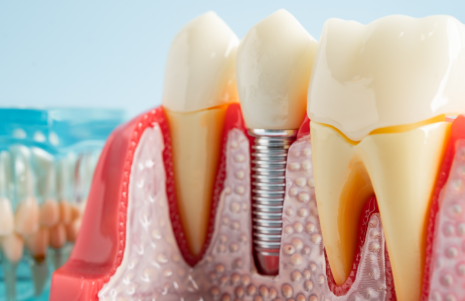Say Goodbye to Gaps with Tipton’s Most Advanced Dental Implant Solutions