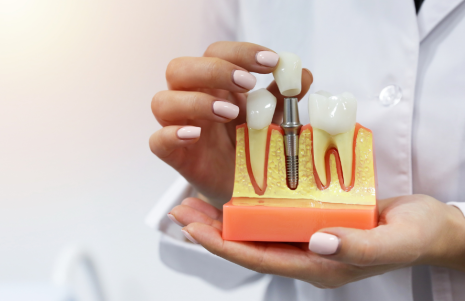 The Life-Changing Impact of Dental Implants for our Bilston Patients