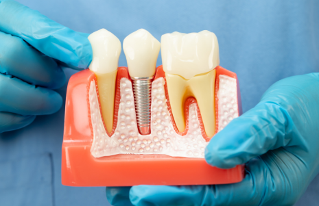 Reclaim Your Confidence with State-of-the-Art Dental Implants in Coseley