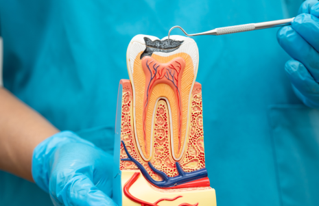 How Root Canal Treatment Works and Why It Is Done