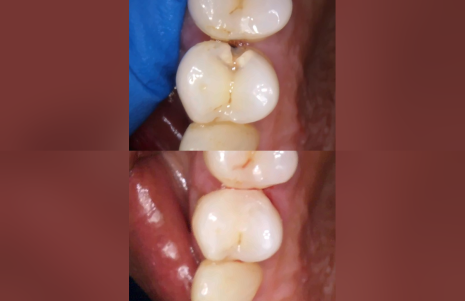 Before and after composite filling at Roseville Dental, Coseley – decayed back tooth restored with a tooth-coloured composite filling