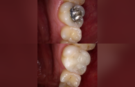 Before and after composite filling at Roseville Dental, Coseley – old silver amalgam filling replaced with a tooth-coloured composite filling