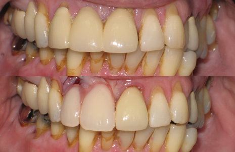 Before and after immediate denture at Roseville Dental, Coseley – failing front bridge replaced with an immediate denture
